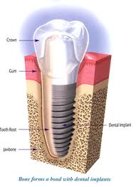 Cosmetic Dental Implants
