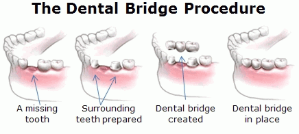 Dental Bridges
