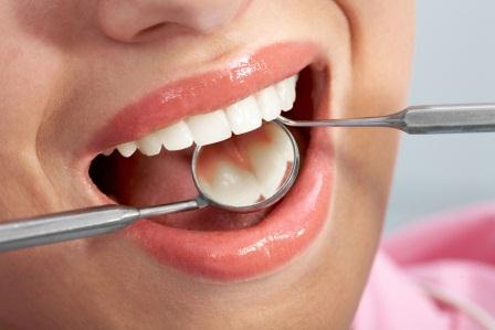Tooth Colored Fillings