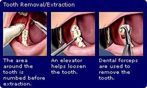Dr. Arnold removes teeth.